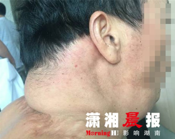 46 歲男子日飲半斤酒 喝出河馬脖變超人
