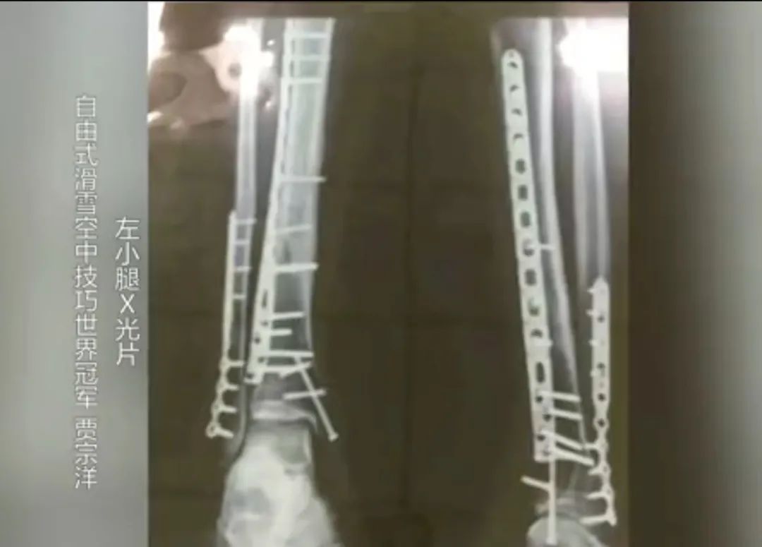賈宗洋個(gè)人資料簡(jiǎn)介 賈宗洋身上有多少鋼釘 賈宗洋個(gè)人資料簡(jiǎn)介 賈宗洋身上有多少鋼釘