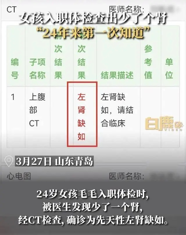24歲女孩入職體檢查出少一個腎 確診為先天性左腎缺如